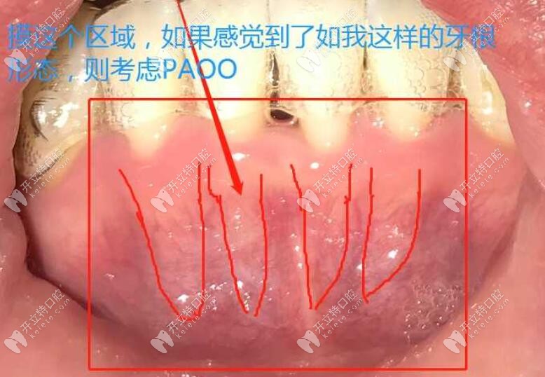 为什么要行paoo牙周手术