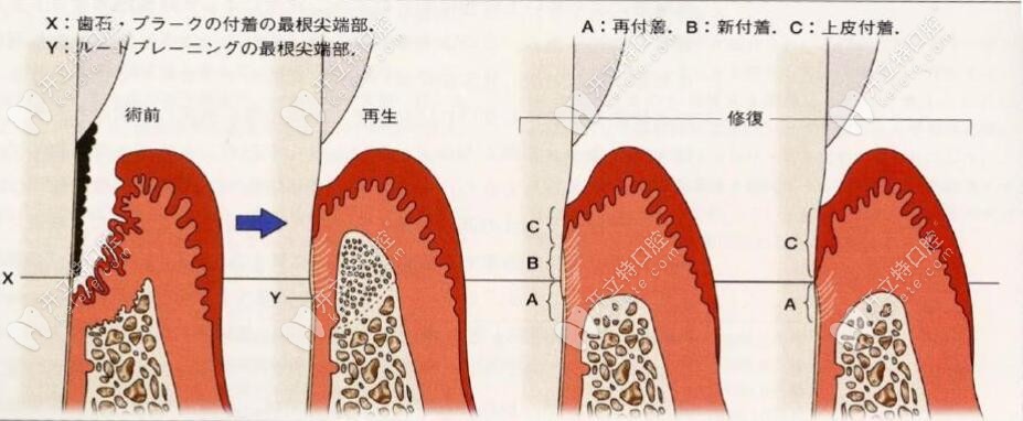 paoo牙周的手术步骤