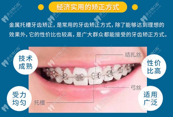 金属矫正的优势点也不少