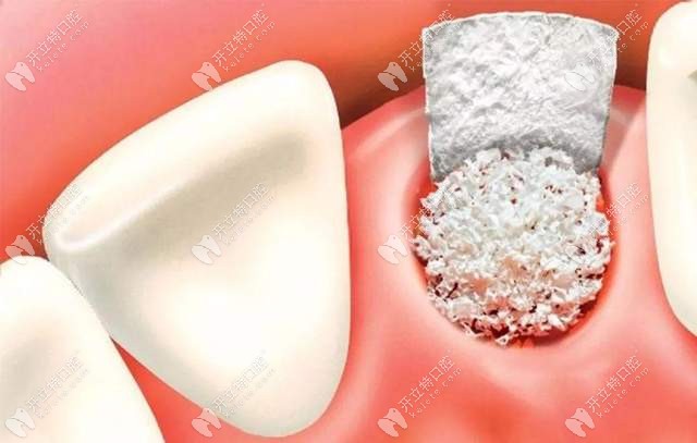 牙龈萎缩骨量不足需要植骨粉