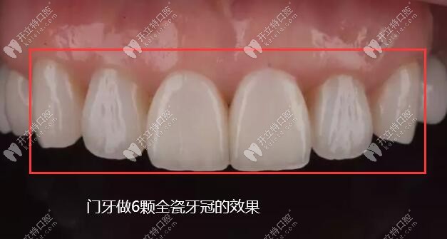 牙体缺损做的德国威兰德全瓷牙冠修复后的效果图