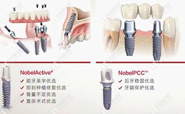 诺保科（诺贝尔）种植牙的优点