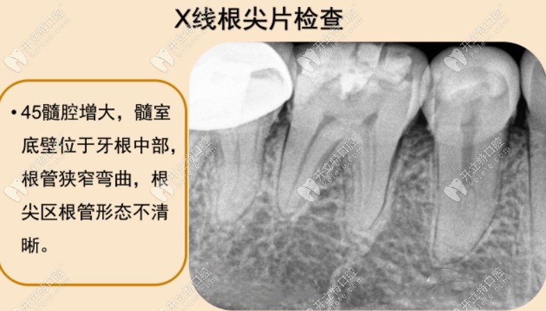 牛牙症临床表现