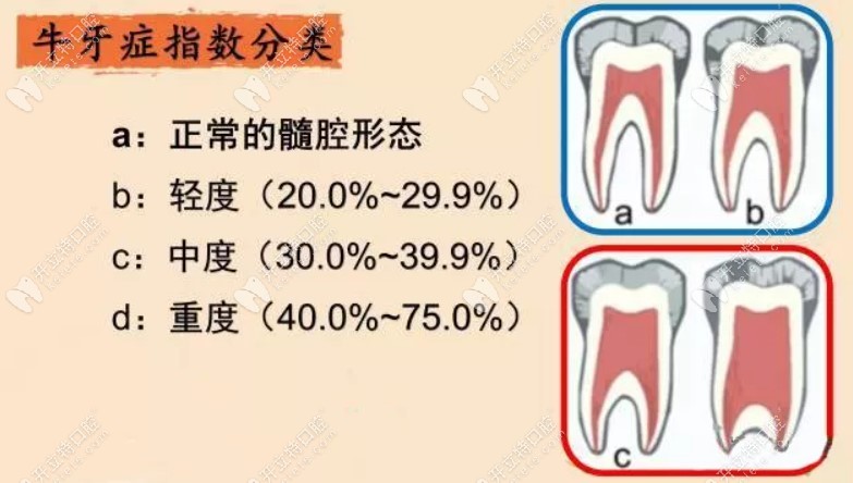 什么是牛牙样牙？牛牙症可以做牙齿矫正吗？