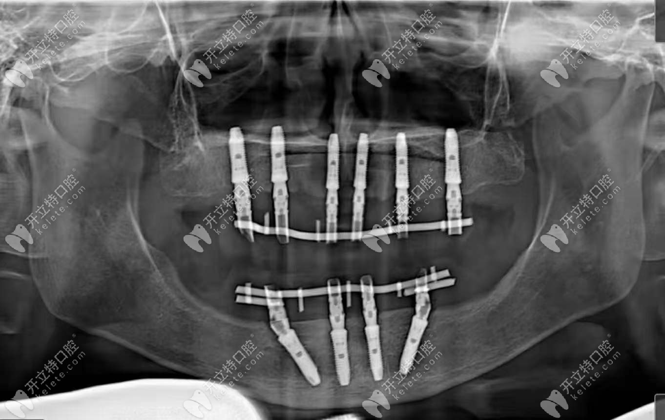 全口种植牙CT照