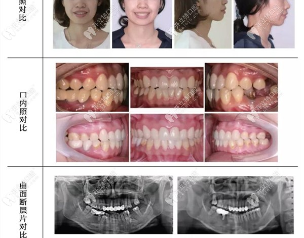 多生牙牵引矫正前后效果对比
