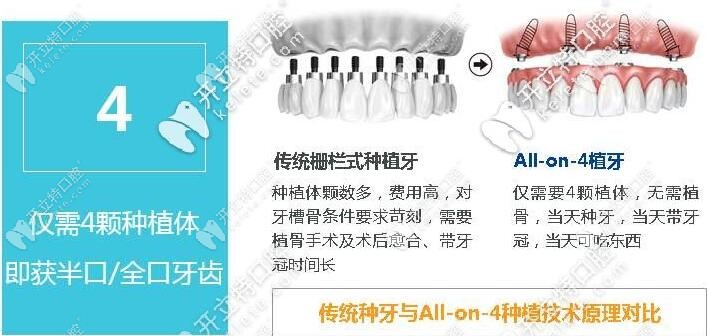 荷塘晶钻口腔all-on-4种植牙技术优势