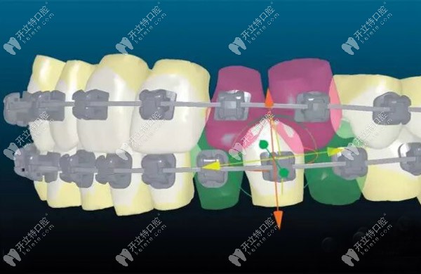 临沂兰山区牙科做传统钢丝矫正牙齿的费用5K+