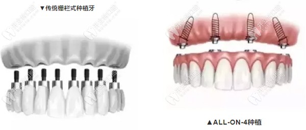 什么是all-on-6种植牙技术