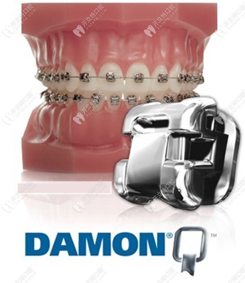Damon Q牙套的外观