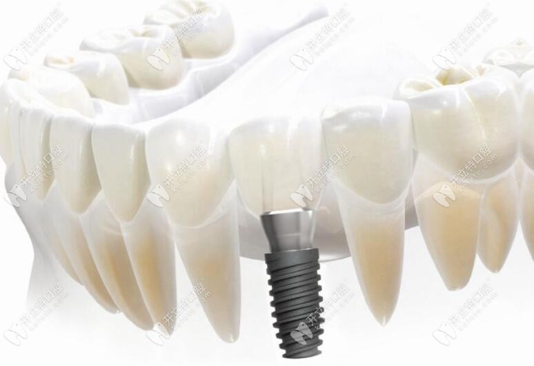 牙齿修复技术