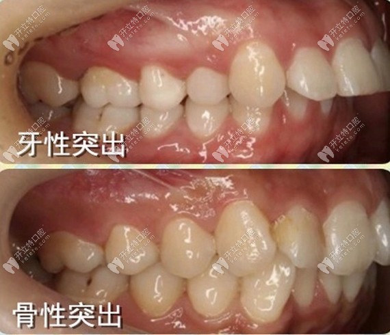 这是牙性突出和骨性突出的对比