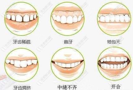 隐形牙套可以矫正的畸形牙齿