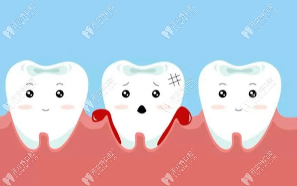 忽略种牙细节，种植牙后会有后遗症