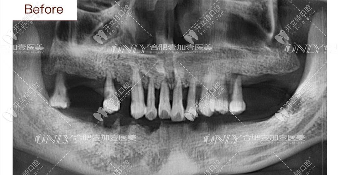 下半口牙齿缺失病例