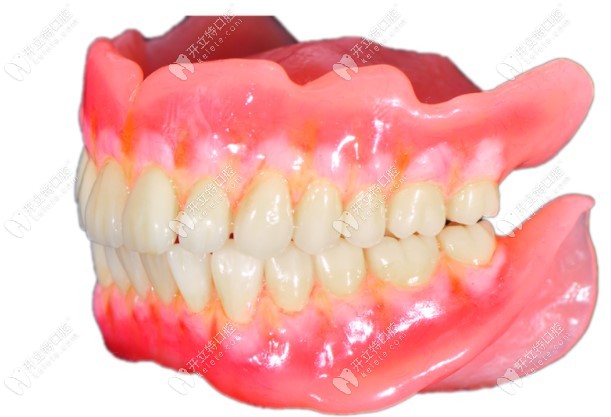 BPS全口吸附性义齿照片