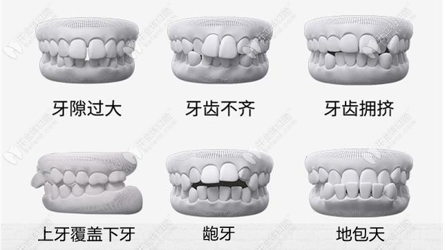 福州登特牙科牙齿矫正的收费标准