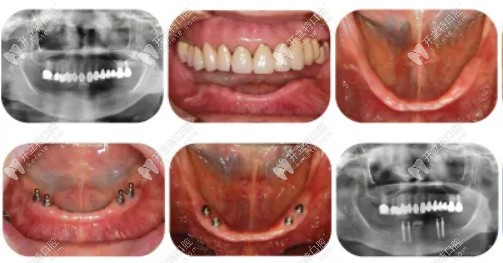 韩国奥齿泰种植牙的临床病例