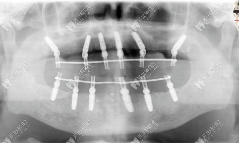 全口allon6即刻负重种植牙后的CT片