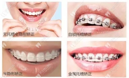 四种牙齿矫正方式