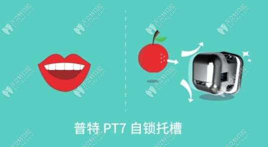 国产牙齿矫正器新品牌-普特PT 7自锁托槽的优势