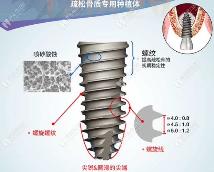 韩国奥齿泰种植体有几种型号