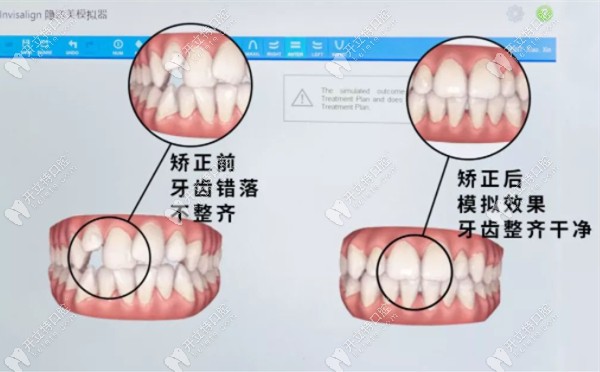 隐形正畸3D模拟对比