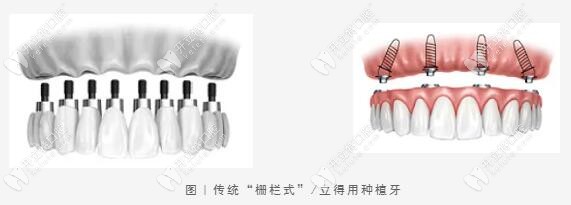 中诺口腔-立得用种植技术