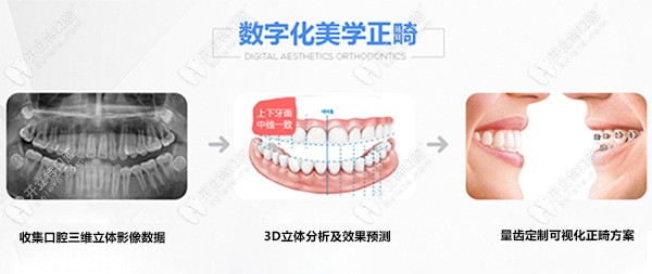 华医口腔的美学正畸