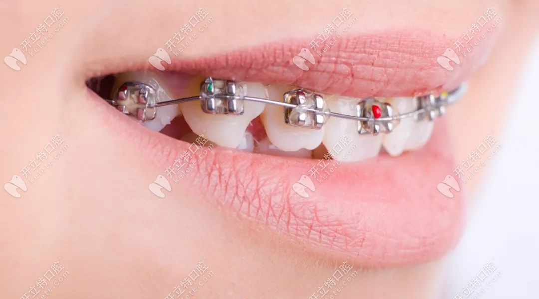 金属牙套的外观
