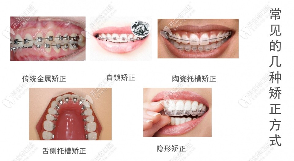 常用的几种牙齿矫正器