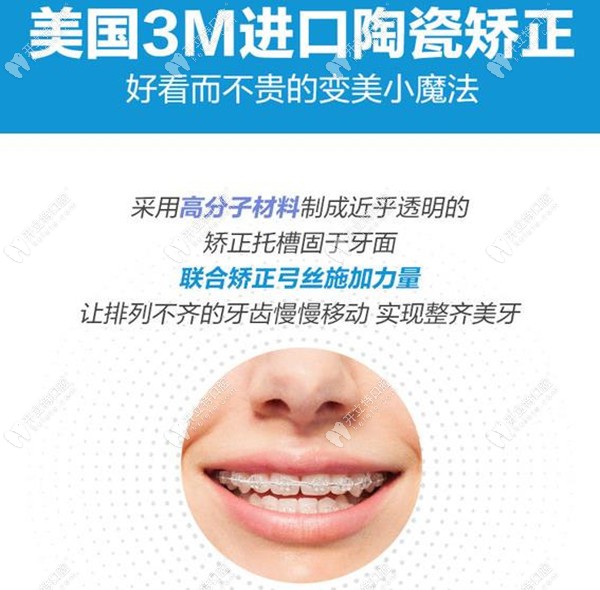 半隐形陶瓷托槽矫正器的收费标准