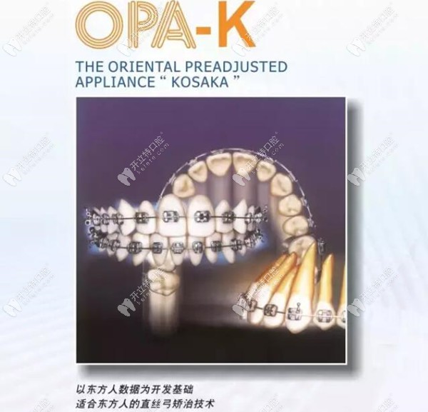 关注：日本拓美tomy OPA-K直丝弓自锁矫治技术怎么样