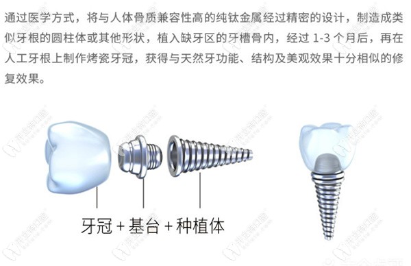 种植牙的简单介绍