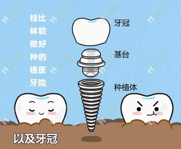 看了广西桂林种植牙哪家医院好?怎能不知桂林种植牙的费用