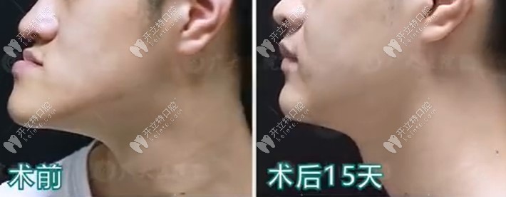 骨性地包天在广州广大做正颌手术病例合集,术后脸型变化大