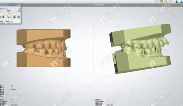 计算机模拟牙齿矫正的状态