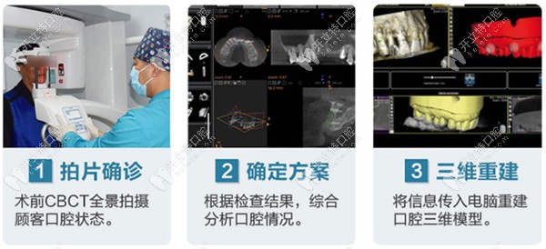 皓亚口腔采用美式定制种植牙技术