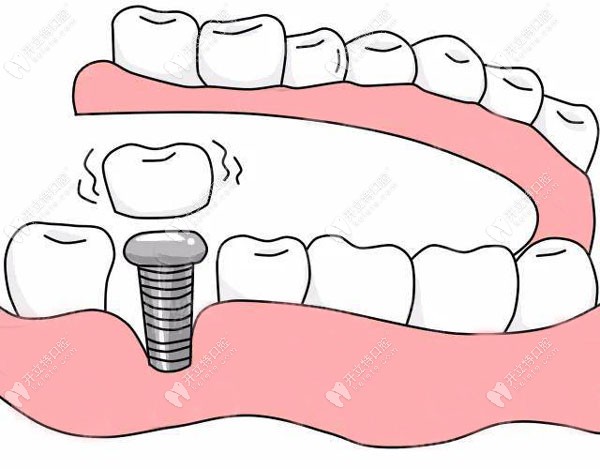 重度牙周病人的种植牙历程