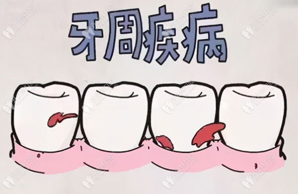 牙周疾病不容小觑