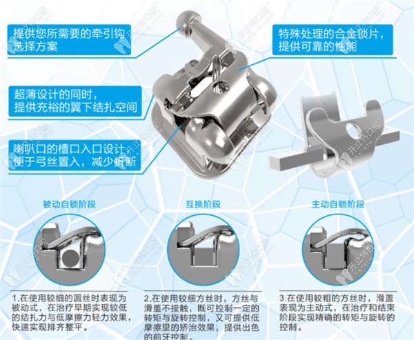 自锁托槽埃蒙迪和普特哪个好这两个国产正畸品牌大pk开始