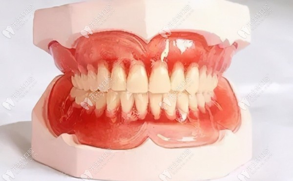 bps生物功能吸附性义齿