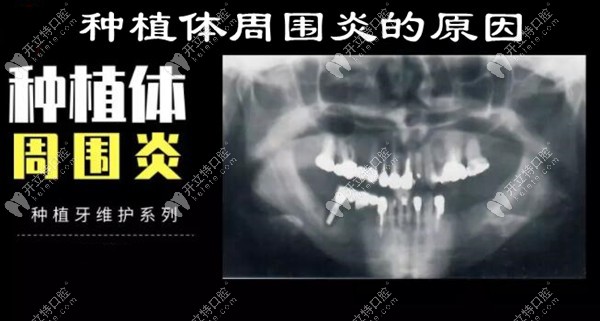 种植体周围牙槽骨组织吸收及萎缩的原因