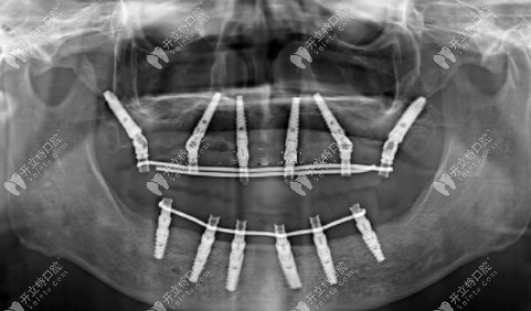 种牙后拍的CT，满口一共种了12种植体