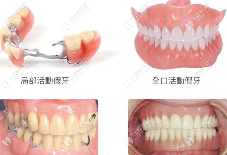 牙托用纯钛和钛合金哪个好？