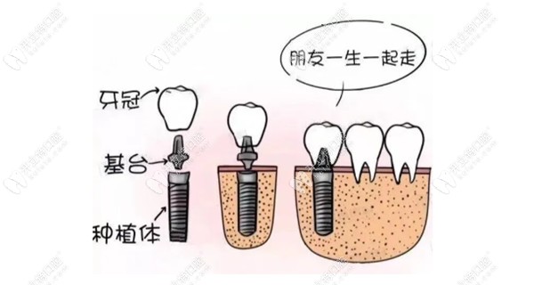 有牙周炎为啥不能做种植牙呢