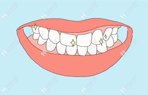 牙齿瓷贴面的优势介绍