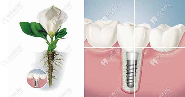 3d数字化微创种植牙和传统种植牙技术的区别，种牙须知