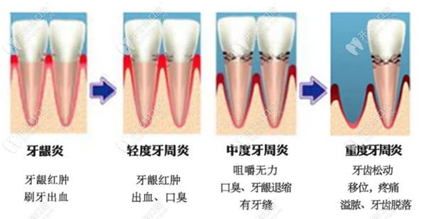 牙周炎的症状