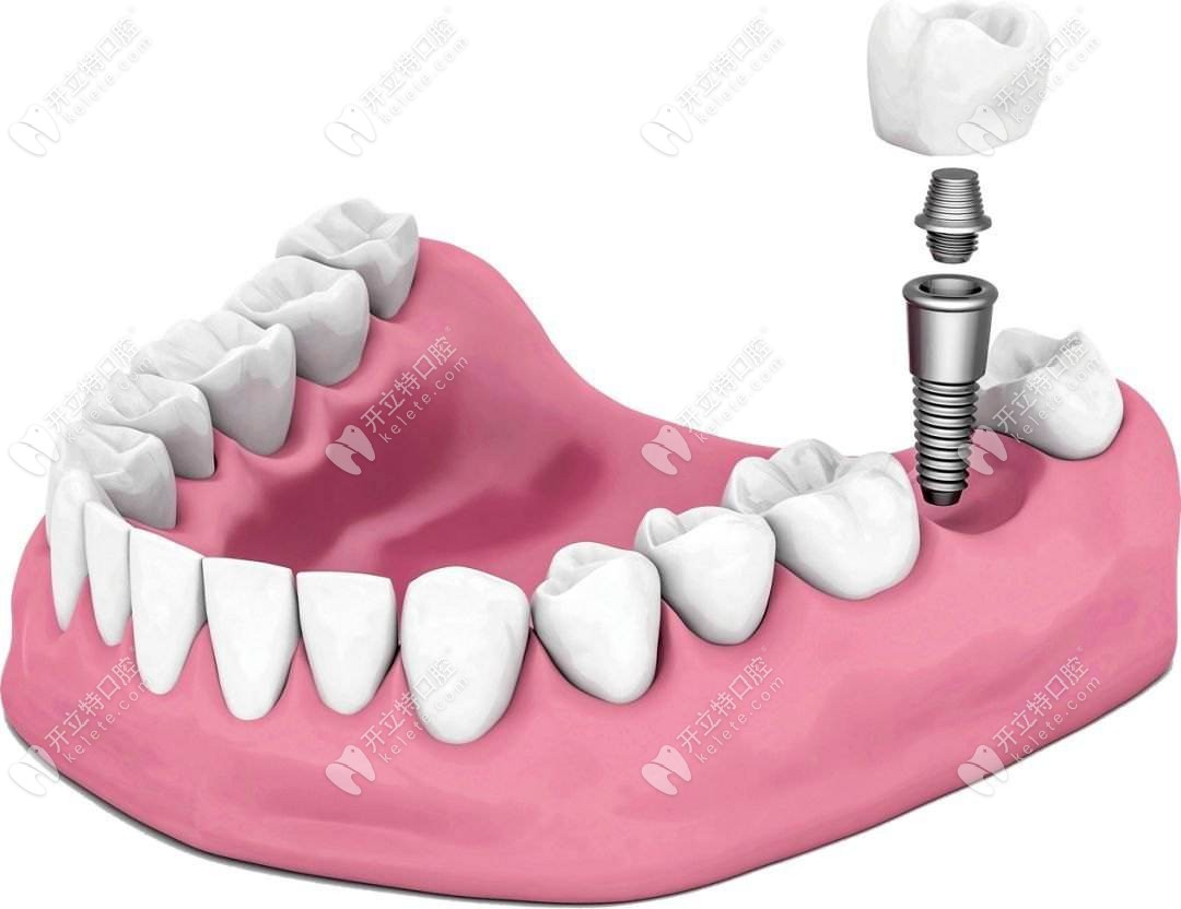 贝臣齿科单颗种植牙补贴